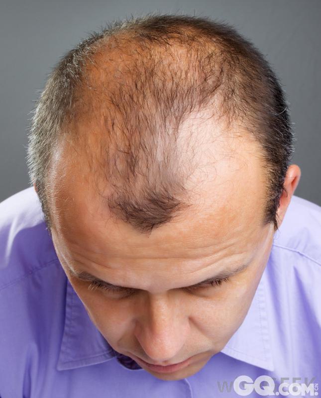 正常人每天大概脱落100根头发，超过这个数目就表示有脱发问题。治疗首先要明确病因，脱发的病因大致分为三类。
